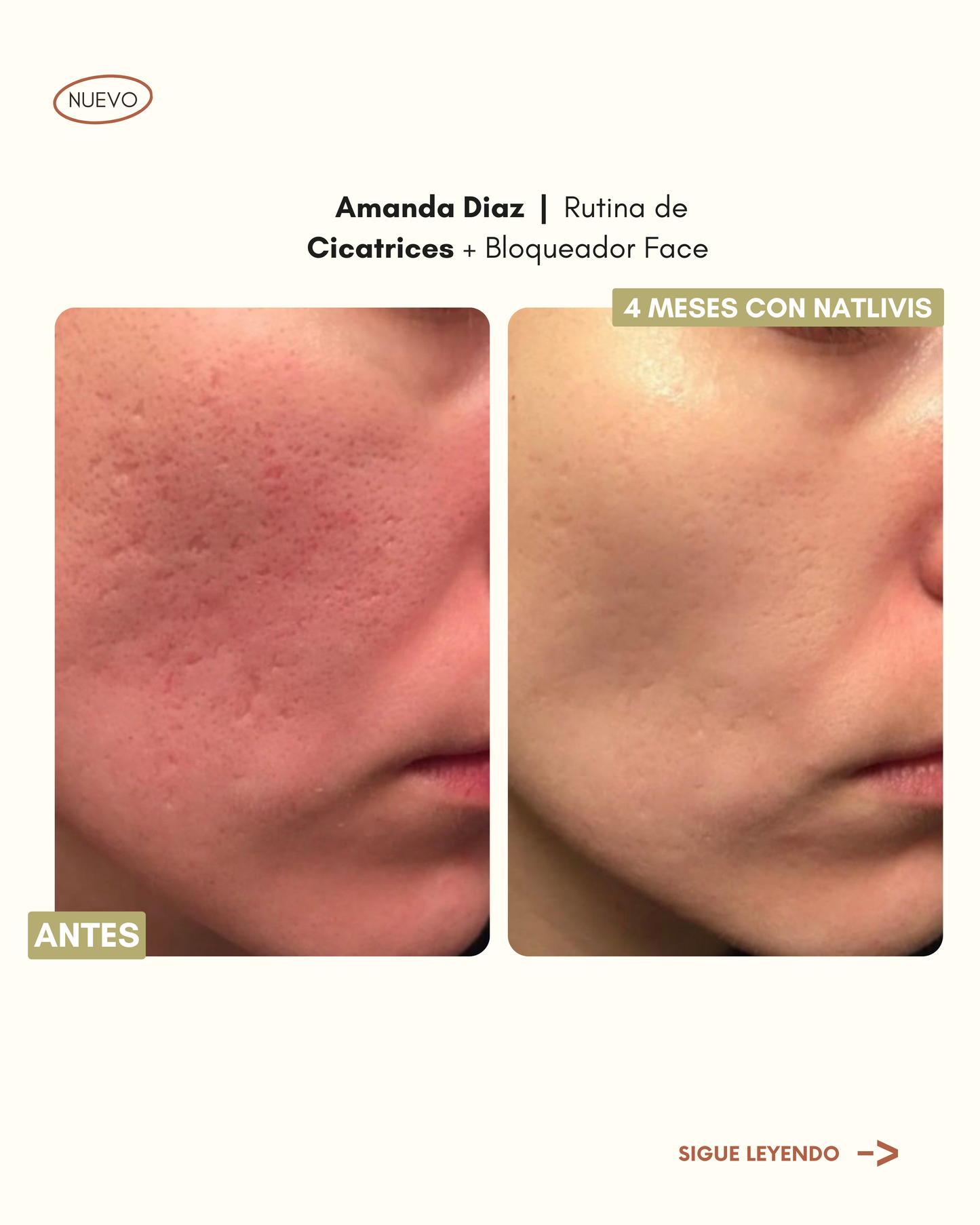 Rutina para Cicatrices