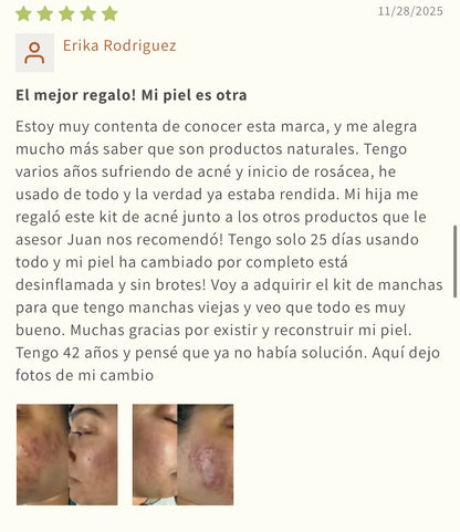 Rutina para Acné